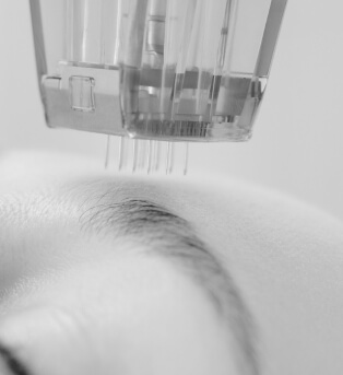 Microneedling in Libertyville