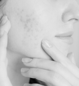 Who May Be a Candidate for Microneedling